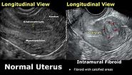 Uterus Ultrasound Normal Vs Intramural Fibroid Images | Uterine Leiomyomas USG Cases