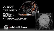 Case of the Week: Ovarian Mucinous Cystadenocarcinoma (Ultrasound & MRI)