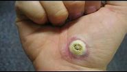 PLANTAR WART REMOVAL DUCT TAPE: This Method Is The Only One That Has Worked For Me.