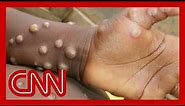 Monkeypox - how does it spread and what are the symptoms?