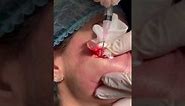 Subcision for Acne Scars of the Cheeks