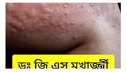 এলার্জি #allergy #urticaria #itching #skinrashes #drgsmukherjee #bestdermatologist #bestskinspecialist #bestdoctorforallergy #dermatologist Dr. G S Mukherjee - Dermatologist, cosmetologist and sexologist | Dr. G S Mukherjee - Dermatologist, cosmetologist and sexologist