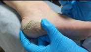 Pedicure : Wow! Look at cracked heels. Dead skin removal and Cracked heels treatment.
