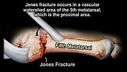 Metatarsal Fractures, jones fracture