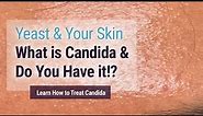 Yeast affecting your skin? You may have it and not know! (Candida Albicans)