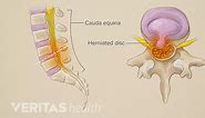 The Essentials of Sciatic Nerve Pain Patterns