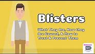 Blisters - What They Are, How they Are Caused, & How to Treat & Prevent Them