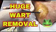 Large Wart Removal from Foot