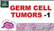 OVARIAN TUMORS - Part 4: Germ cell tumors: Dysgerminoma, yolk sac tumor - Pathology