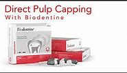 Biodentine Direct Pulp Capping - Improve Pulp Capping Success Rate | Techniques and Material 2022