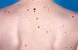 Familial Melanoma Images