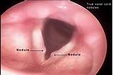 Benign Vocal Cord Lesions Images