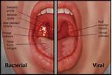 Leukemia Symptoms Sore Throat Images