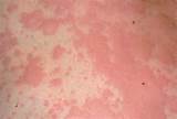 Pictures of Diseases With Rashes