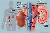 Images of Kidney Chronic