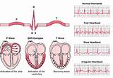 Pictures of Heart Rhythm Symptoms