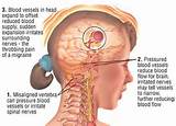 Migraine Headache Drugs Images