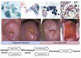 Throat Cancer Progression Images