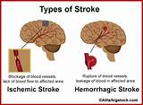 Pictures of Ischemic And Hemorrhagic Stroke