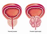 The Cause Of Prostate Cancer Images