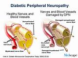 Pictures of Diabetic Nerve Damage Symptoms