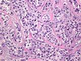 Images of Grade 2 Breast Cancer