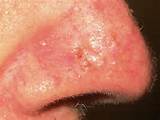Basal Cell Carcinoma Photo Pictures
