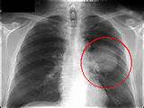 Images of X Ray Of Cancerous Lung