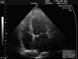 Mitral Valve Prolapse Ultrasound Images