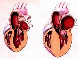 Photos of Heart Hypertrophy Symptoms
