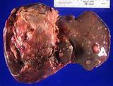 Images of Melanoma Liver Metastases