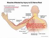 Shoulder Nerve Damage Symptoms Images