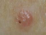 Pictures of Symptoms Of Melanoma Skin Cancer