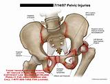 Photos of Pelvic Joint Pain