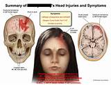 Pictures of Head Injuries Symptoms