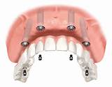 Best Dental Implants