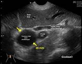 Images of Prominent Ducts Breast Ultrasound