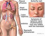 Pictures of Leukemia Lupus Symptoms
