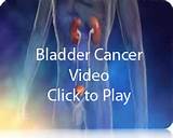 Bladder Cancer Symptoms Photos