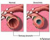 Photos of Chronic Bronchitis Treatment