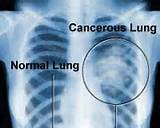 Images of X Ray Findings In Lung Cancer