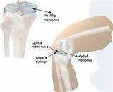 Cartilage Knee Injury Photos