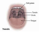 Cancer Tonsils Symptoms Pictures