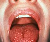 Throat Cancer Or Anxiety Images