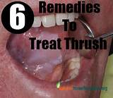 Thrush Alternative Treatment Photos