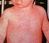 Symptoms Of Measles Images