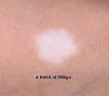 Images of Vitiligo Skin Cancer