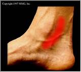 Medial Foot Pain Pictures