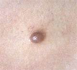 Pictures of Melanoma Size
