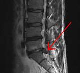 Herniated Disc Symptoms Pictures
